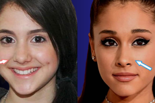 Ariana Grande Plastic Surgery: Before and After Transformation