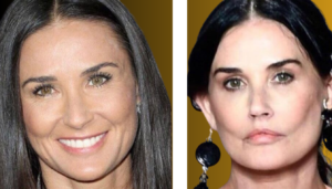 Demi Moore Plastic Surgery: Before and After Transformation Revealed